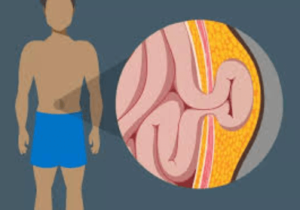 Can Hernia Be Treated Without Surgery?